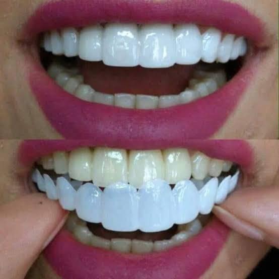 Snap on Smile-Pro : Confort et ajustement parfait