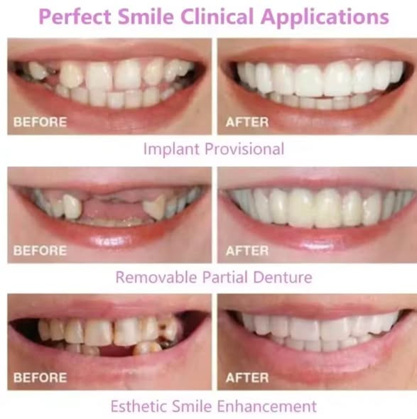 Snap on Smile-Pro : Confort et ajustement parfait