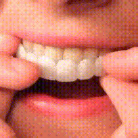 Snap on Smile-Pro : Confort et ajustement parfait